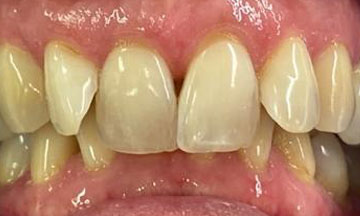 Before Invisalign treatment in Barnes South London image 2